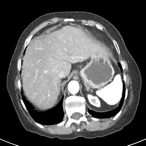 Ampullary adenocarcinoma (Radiopaedia 34013-35237 B 13).png