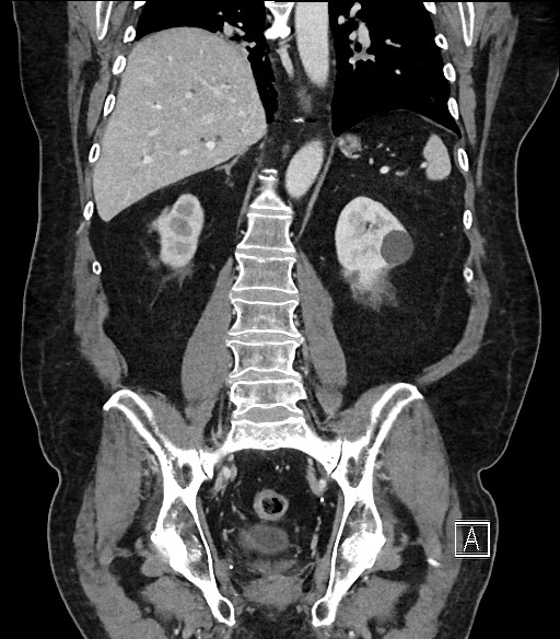 Ampullary adenocarcinoma (Radiopaedia 59373-66734 D 74).jpg