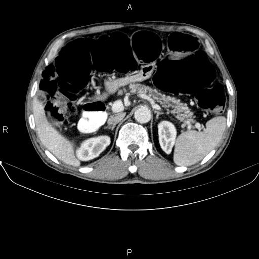 Ampullary adenocarcinoma (Radiopaedia 86093-102032 A 19).jpg