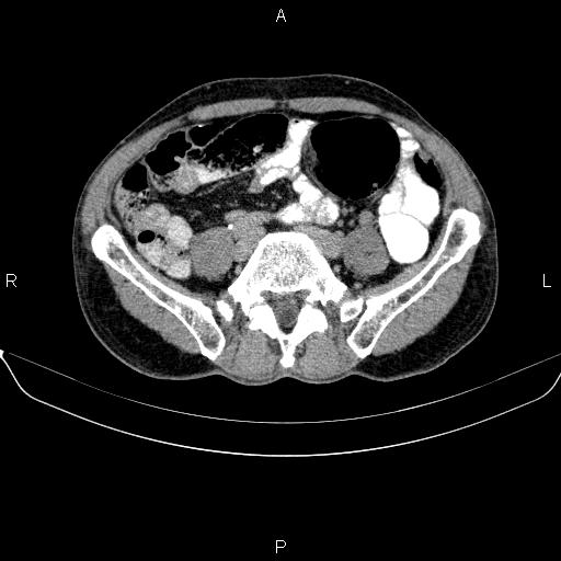 Ampullary adenocarcinoma (Radiopaedia 86093-102032 Axial C+ delayed 73).jpg