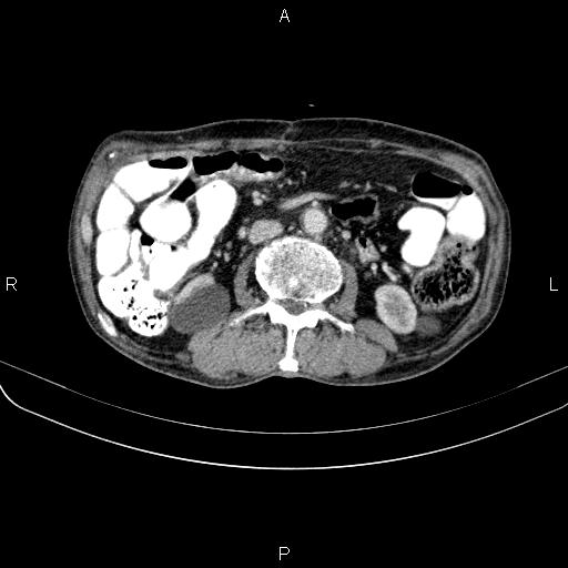 Ampullary adenocarcinoma (Radiopaedia 86093-102033 B 71).jpg
