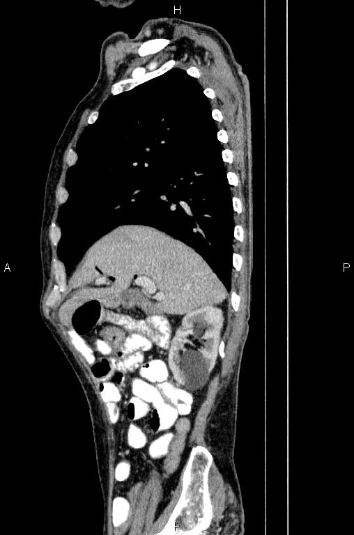 Ampullary adenocarcinoma (Radiopaedia 86093-102033 E 26).jpg