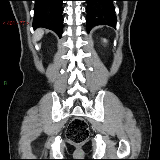 Ampullary carcinoma (Radiopaedia 56396-63056 E 76).jpg