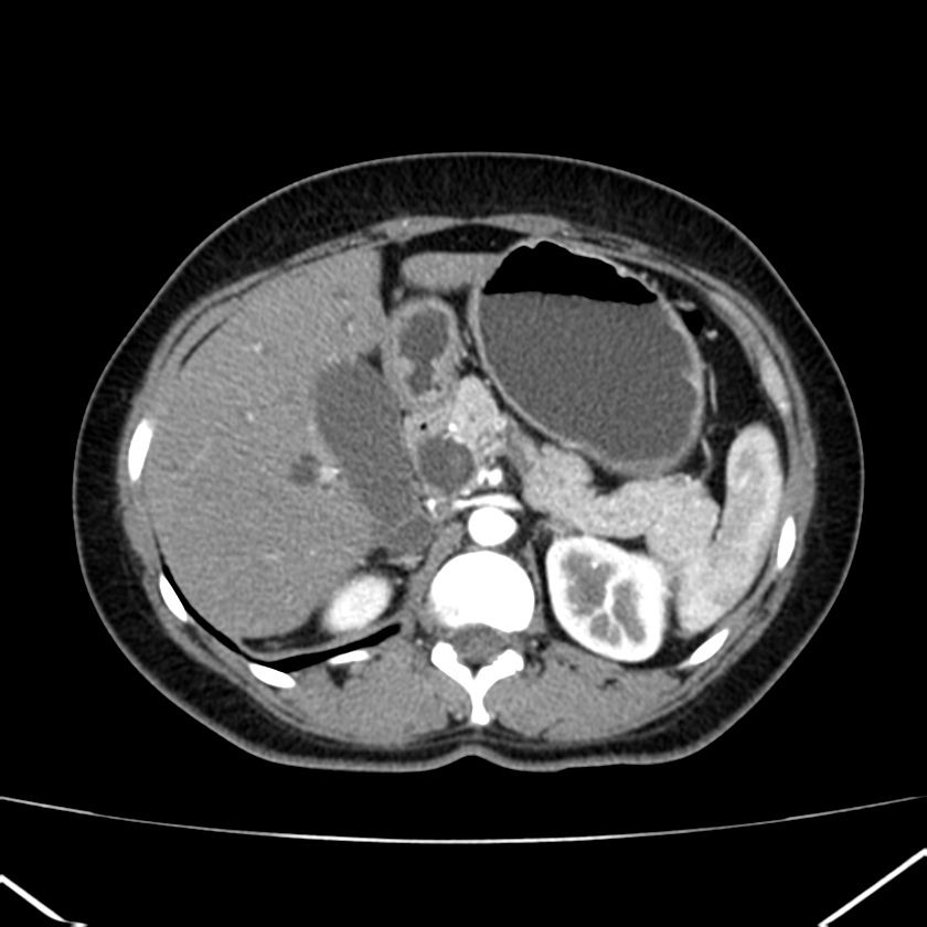 Ampullary tumor (Radiopaedia 22787-22816 B 29).jpg