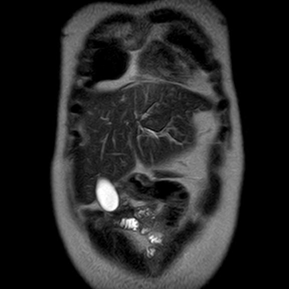 File:Ampullary tumor (Radiopaedia 27294-27479 Coronal T2 3).jpg