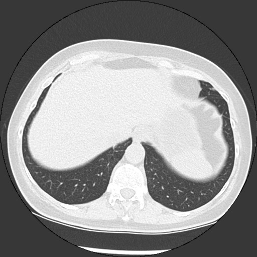 Amyloidosis - bronchial and diffuse nodular pulmonary involvement (Radiopaedia 60156-67744 B 49).jpg