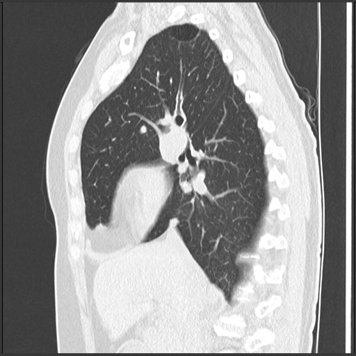 Amyloidosis - bronchial and diffuse nodular pulmonary involvement (Radiopaedia 60156-67744 F 23).jpg