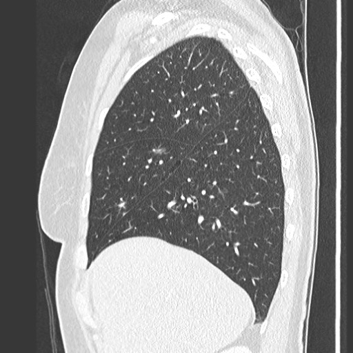 Amyloidosis - bronchial and diffuse nodular pulmonary involvement (Radiopaedia 60156-67745 Sagittal lung window 21).jpg