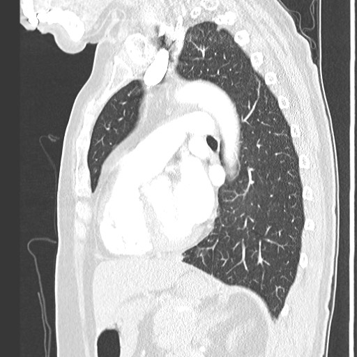Amyloidosis - bronchial and diffuse nodular pulmonary involvement (Radiopaedia 60156-67745 Sagittal lung window 55).jpg