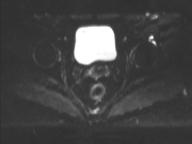 Anal adenocarcinoma - tumor regression grade 1 (Radiopaedia 31358-32100 Axial DWI 20).jpg