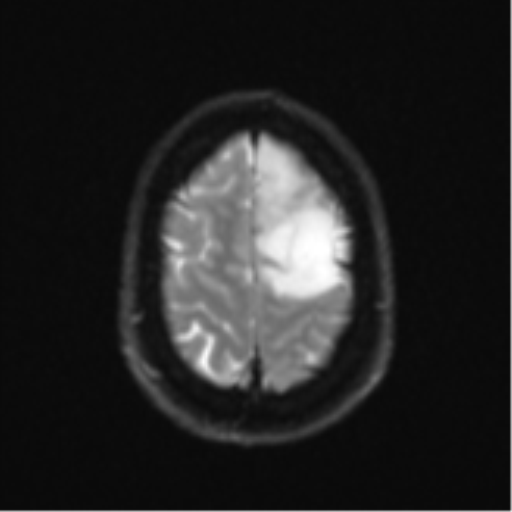 Anaplastic astrocytoma (Radiopaedia 57768-64731 Axial DWI 25).png