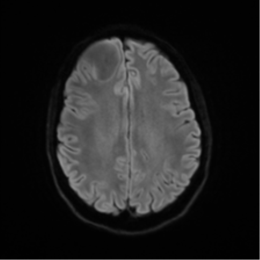 File:Anaplastic astrocytoma IDH mutant (Radiopaedia 50046-55341 Axial DWI 46).png