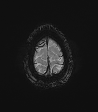 File:Anaplastic astrocytoma IDH mutant (Radiopaedia 50046-55341 Axial SWI 81).png