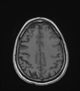 Anaplastic astrocytoma IDH wild-type (Radiopaedia 49984-55273 Axial T1 43).png