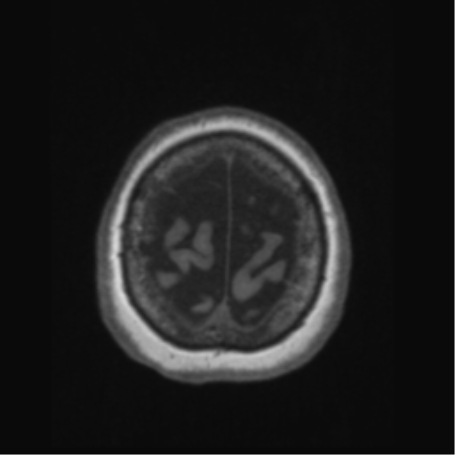 File:Anaplastic astrocytoma IDH wild-type (pseudoprogression) (Radiopaedia 42209-45276 Axial T1 135).png