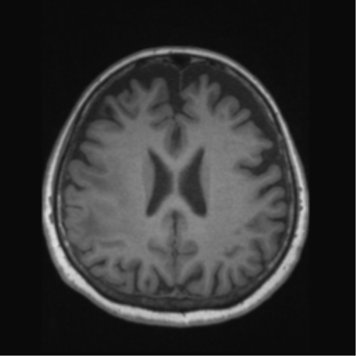 Anaplastic astrocytoma IDH wild-type (pseudoprogression) (Radiopaedia 42209-45276 Axial T1 98).png