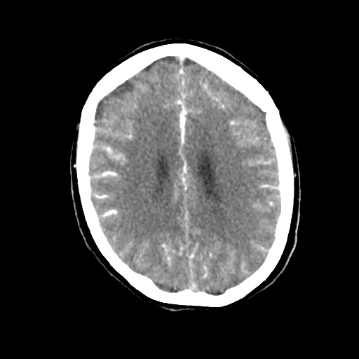Aneursym related subarachnoid hemorrhage with hydrocephalus (Radiopaedia 45105-49084 D 36).jpg