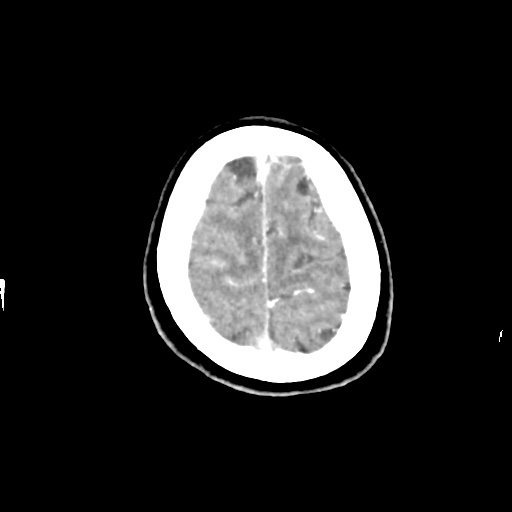 Aneursym related subarachnoid hemorrhage with hydrocephalus (Radiopaedia 45105-49084 D 48).jpg