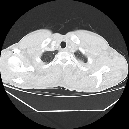 Aneurysmal bone cyst - rib (Radiopaedia 82167-96220 Axial lung window 13).jpg