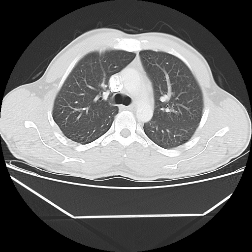 File:Aneurysmal bone cyst - rib (Radiopaedia 82167-96220 Axial lung window 27).jpg