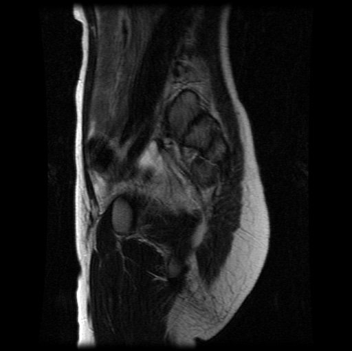 File:Aneurysmal bone cyst - sacrum (Radiopaedia 65190-74196 Sagittal T2 23).jpg