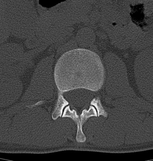Aneurysmal bone cyst T11 (Radiopaedia 29294-29721 Axial bone window 72).jpg
