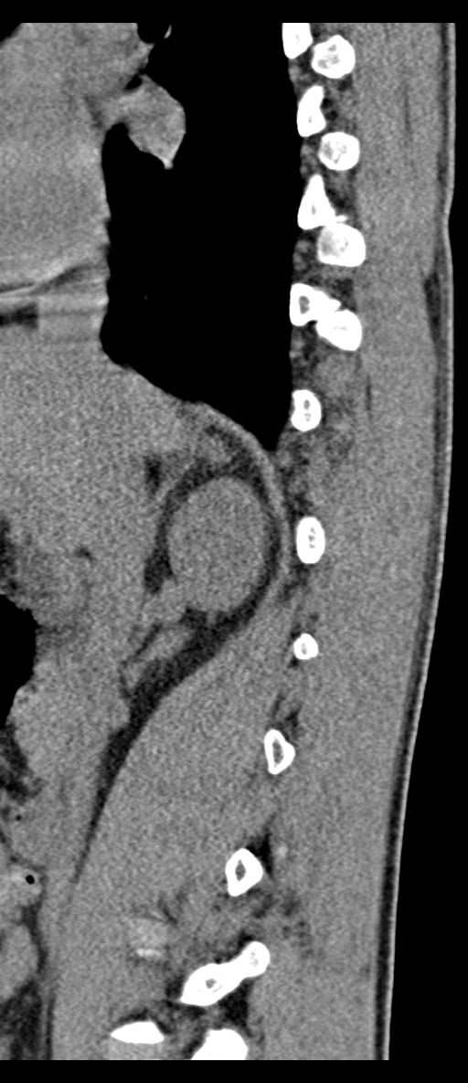 Aneurysmal bone cyst T11 (Radiopaedia 29294-29721 E 59).jpg