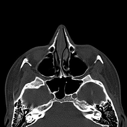 Aneurysmal bone cyst of the mandible (Radiopaedia 43280-46601 Axial bone window 85).jpg