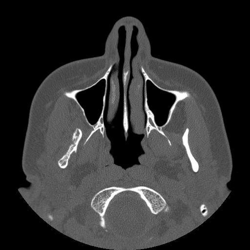 Aneurysmal bone cyst of the mandible (Radiopaedia 43280-46823 Axial bone window 111).jpg