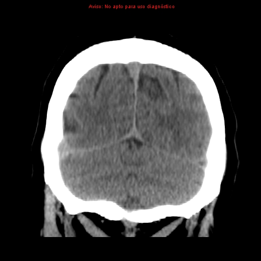 File:Aneurysmal subarachnoid hemorrhage (Radiopaedia 24740-24997 Coronal non-contrast 41).jpg
