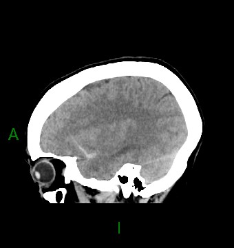 File:Aneurysmal subarachnoid hemorrhage with intra-axial extension (Radiopaedia 84371-99699 B 36).jpg