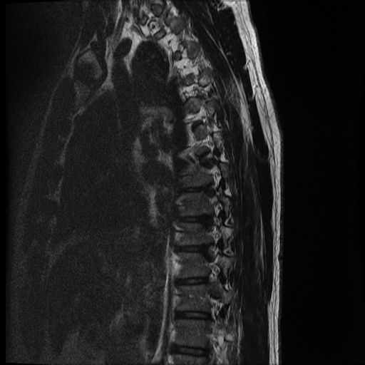 File:Angiolipoma - thoracic spine (Radiopaedia 28242-28479 Sagittal T2 12).jpg