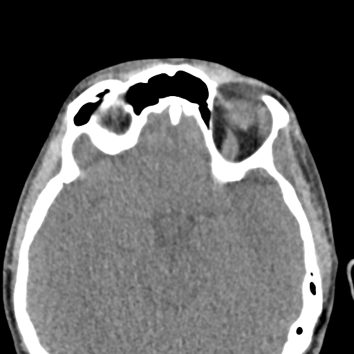 Angular dermoid cyst (Radiopaedia 88967-105790 Axial non-contrast 34).jpg