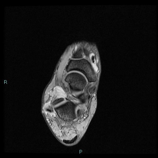 Ankle ganglion cyst (Radiopaedia 62809-71162 Axial Gradient Echo 40).jpg