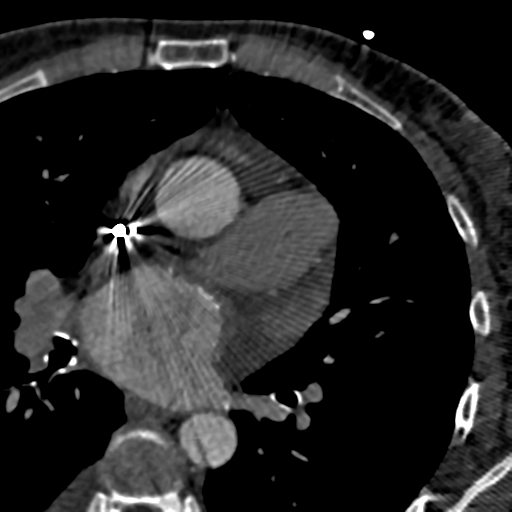File:Anomalous left coronary artery arising from the pulmonary artery (ALCAPA) (Radiopaedia 37167).png