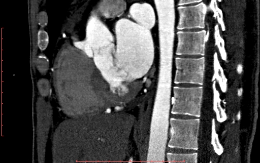 File:Anomalous left coronary artery from the pulmonary artery (ALCAPA) (Radiopaedia 70148-80181 C 120).jpg