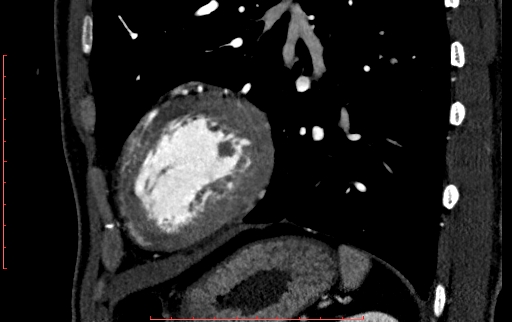 File:Anomalous left coronary artery from the pulmonary artery (ALCAPA) (Radiopaedia 70148-80181 C 209).jpg
