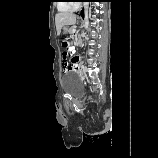 Anorectal carcinoma (Radiopaedia 44413-48064 C 63).jpg