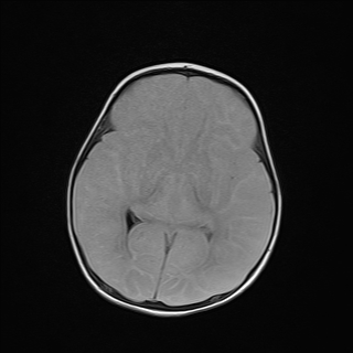 File:Anoxic brain injury (Radiopaedia 79165-92139 Axial FLAIR 14).jpg
