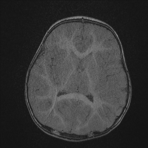 Anoxic brain injury (Radiopaedia 79165-92139 Axial MRA 138).jpg