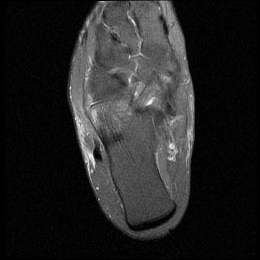 File:Anterior calcaneal process fracture (Radiopaedia 71377-81705 Axial PD fat sat 12).jpg