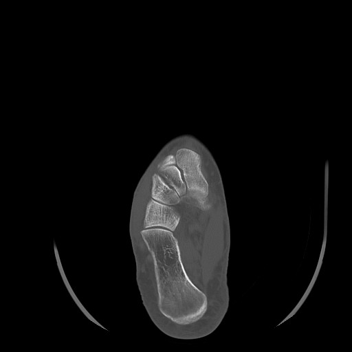 Anterior calcaneal process fracture (Radiopaedia 82590-96762 Axial bone window 26).jpg
