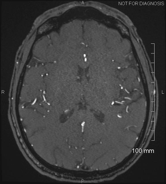 Anterior cerebral artery aneurysm (Radiopaedia 80683-94127 Axial MRA 139).jpg