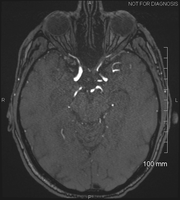Anterior cerebral artery aneurysm (Radiopaedia 80683-94127 Axial MRA 94).jpg