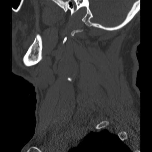 Anterior cervical postdiscectomy arthrodesis (Radiopaedia 32678-33646 Sagittal bone window 2).jpg