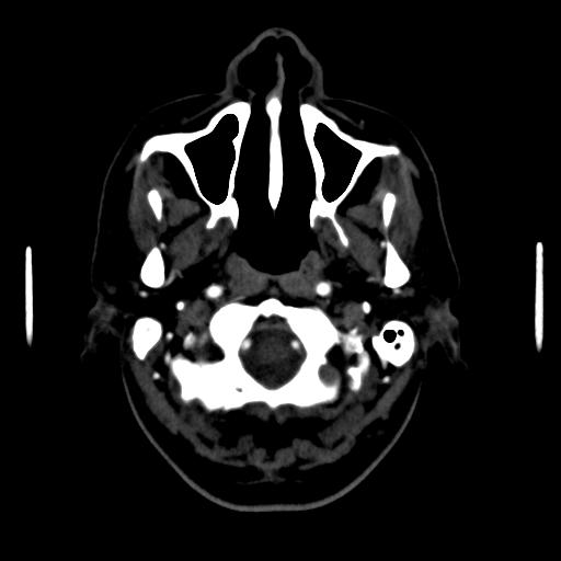 File:Anterior communicating artery aneurysm (Radiopaedia 16633-16335 A 1).jpg