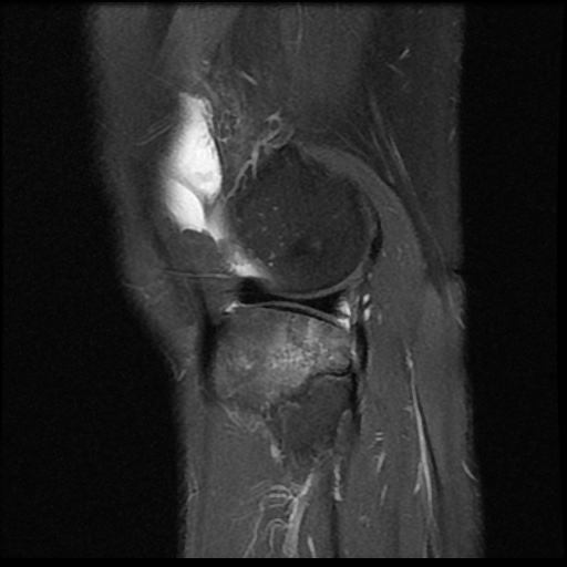 File:Anterior cruciate ligament avulsion fracture (Radiopaedia 58939-66193 Sagittal PD fat sat 5).jpg