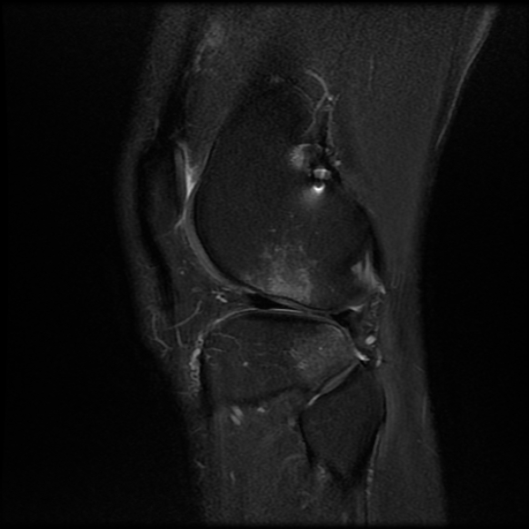 File:Anterior cruciate ligament graft tear and bucket-handle tear of medial meniscus (Radiopaedia 75867-87254 Sagittal PD fat sat 23).jpg