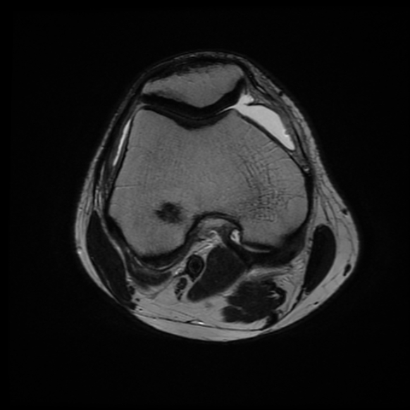 File:Anterior cruciate ligament graft tear and bucket-handle tear of medial meniscus (Radiopaedia 75867-87255 Axial T2 16).jpg