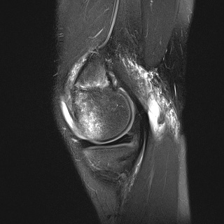 File:Anterior cruciate ligament tear - pediatric (Radiopaedia 62152-70260 Sagittal PD fat sat 10).jpg